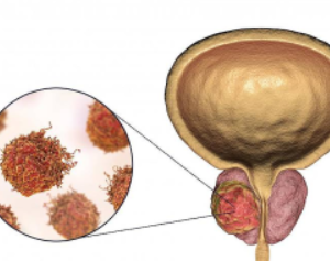 प्रोस्टेट कैंसर (Prostate Cancer)
